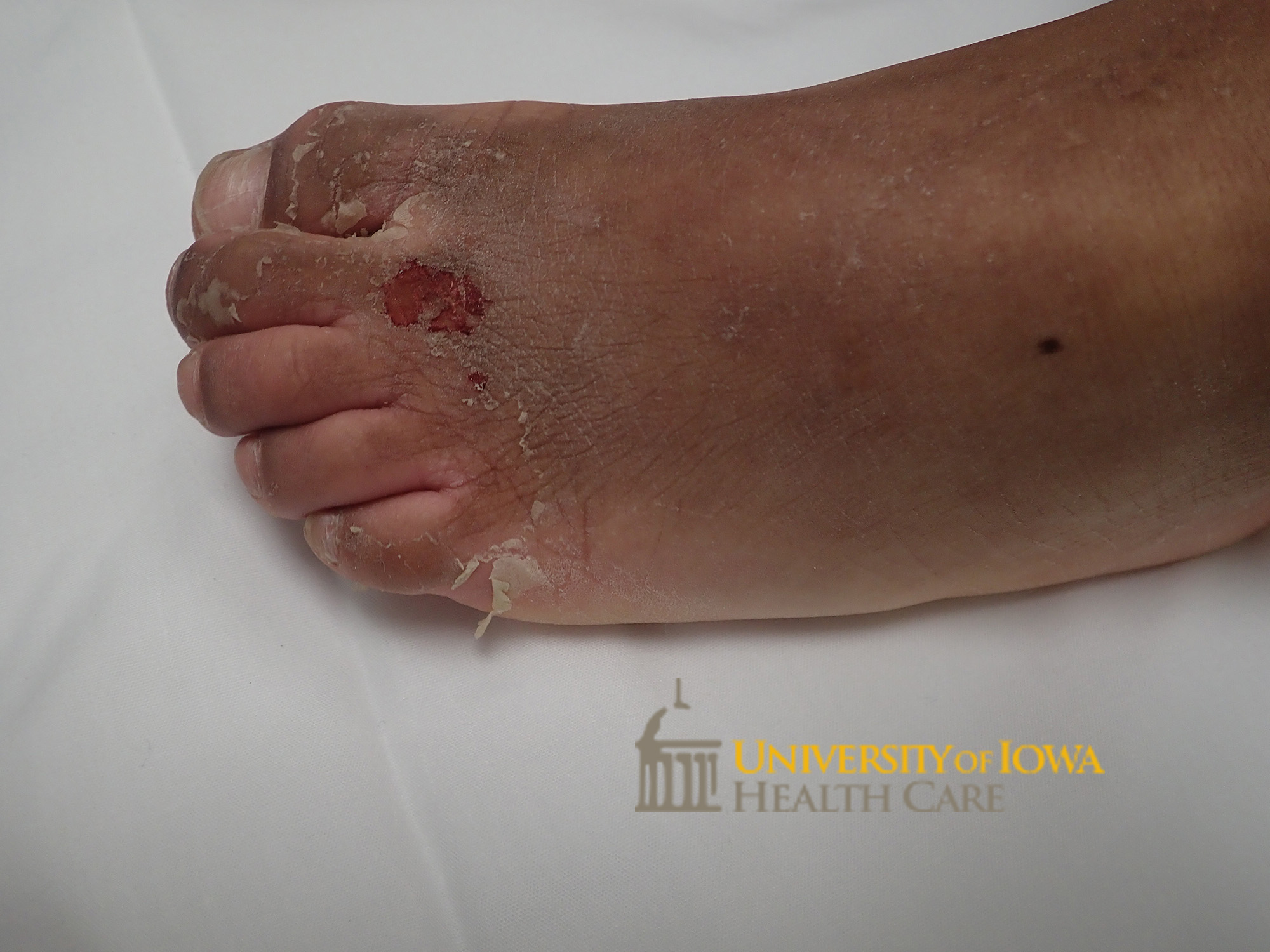 Superficial desquamation and focal area of erosion on the forefoot. (click images for higher resolution).